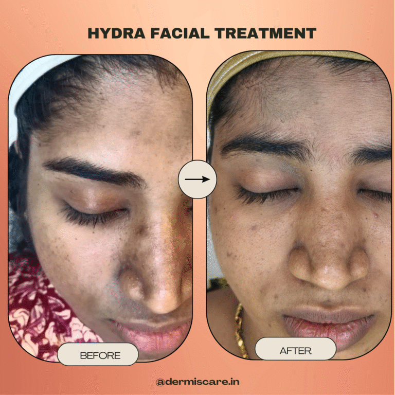clinical hydrafacial treatment in Chennai
