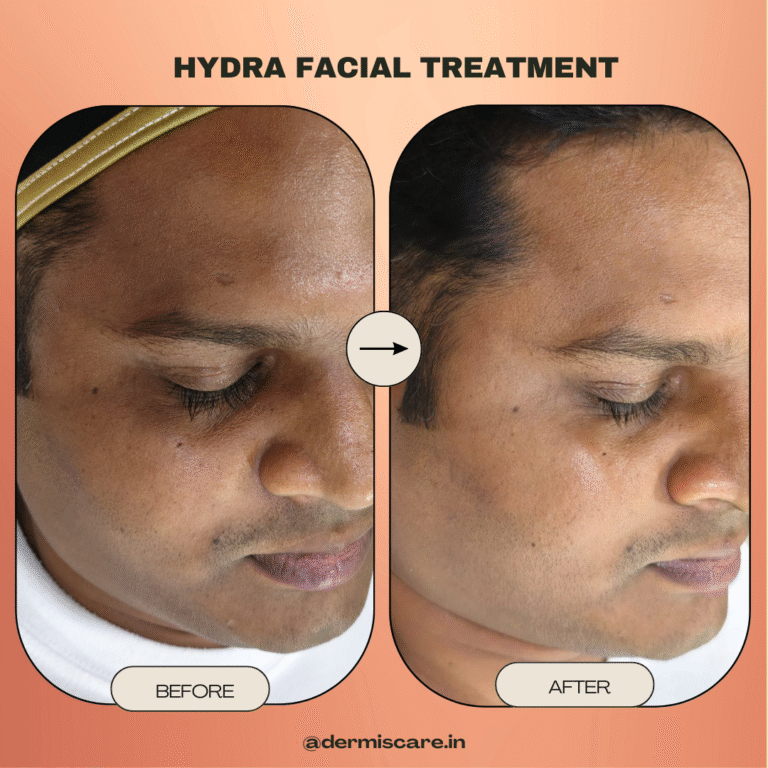 clinical hydrafacial treatment in Chennai