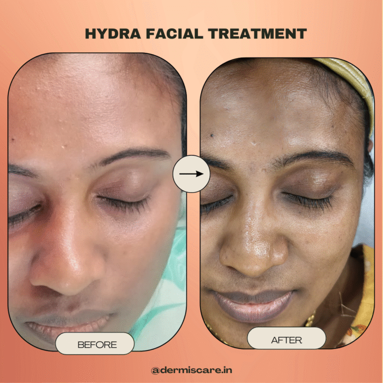 clinical hydrafacial treatment in Chennai