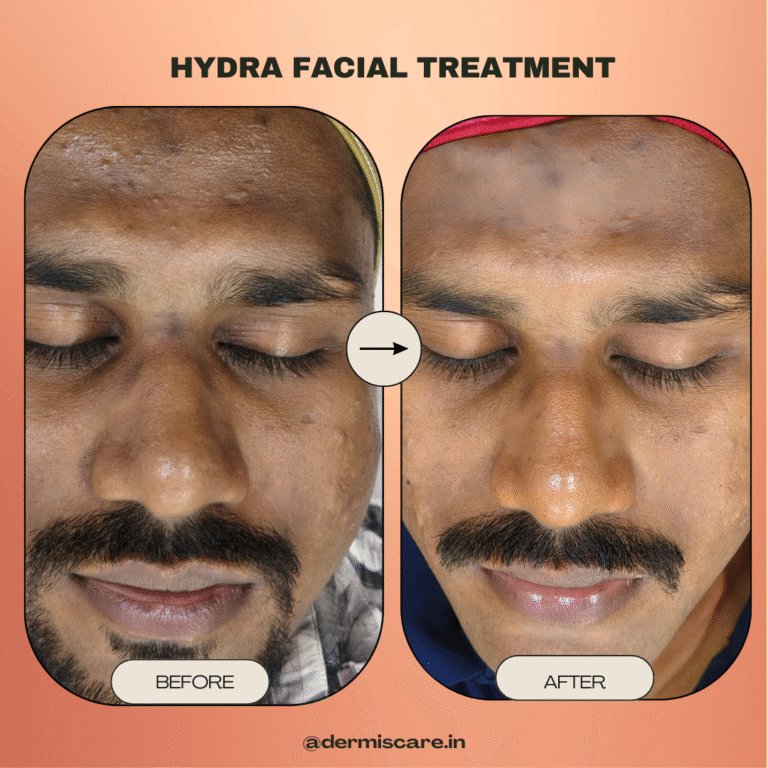clinical hydrafacial treatment in Chennai