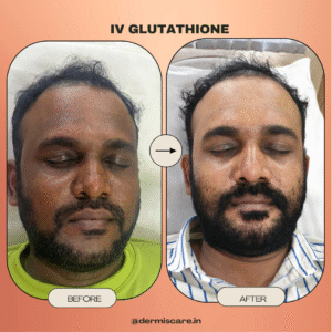 IV Glutathione treatment in Chennai-Dermis Care-Porur & Kilpauk