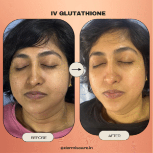 IV Glutathione treatment in Chennai-Dermis Care-Porur & Kilpauk