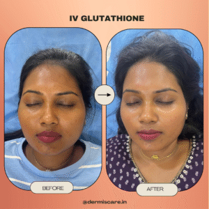 IV Glutathione treatment in Chennai-Dermis Care-Porur & Kilpauk