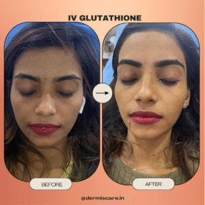 IV Glutathione treatment in Chennai-Dermis Care-Porur & Kilpauk