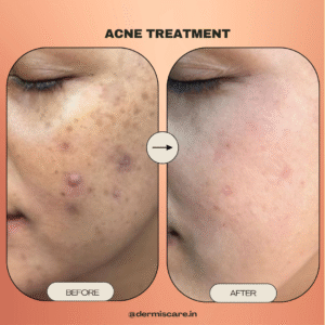 Acne & Pimple Treatment result in chennai by Dermis Care