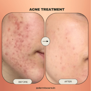 acne & pimple treatment in chennai by DermisCare 