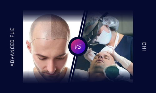 Advanced FUE Vs DHI Hair Transplant in Chennai-Dermiscare-porur & Kilpauk