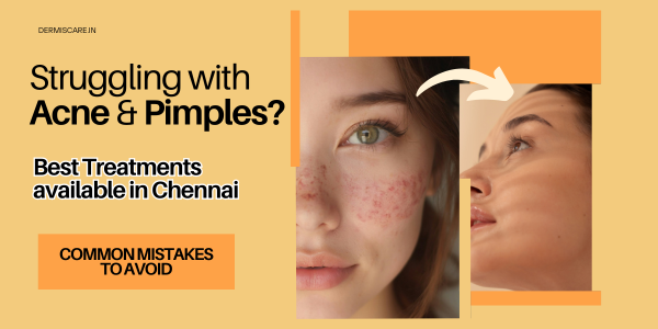 Best Acne & Pimple Treatment in chennai - Dermis Care - Porur & Kilpauk