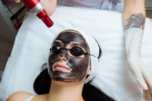 Carbon Laser Facial-Dermiscare-porur & kilpauk