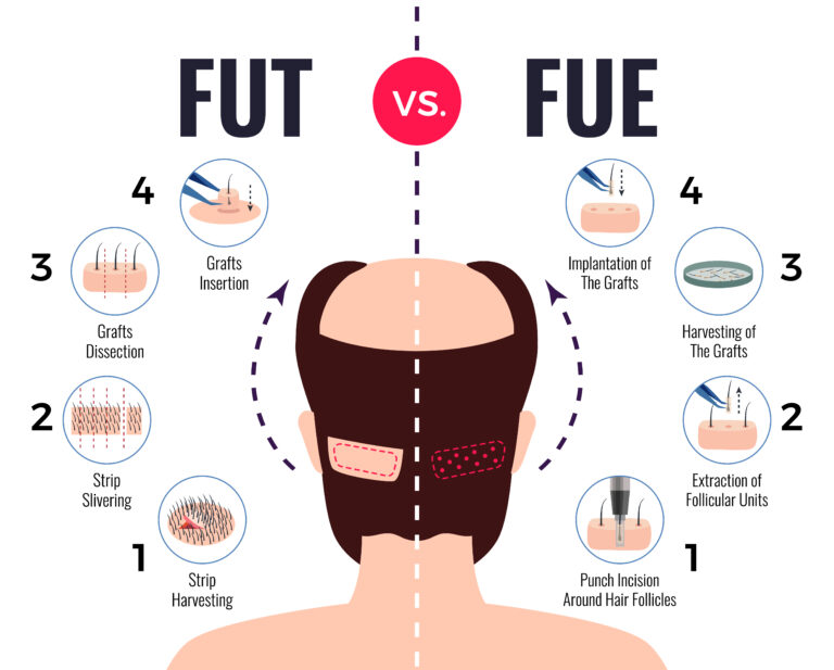 Hair Transplant-Dermisare-porur & Kilpauk