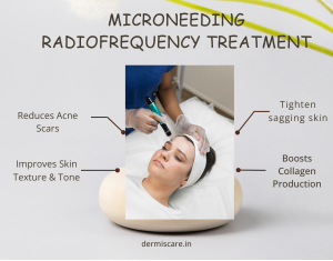 How Long Does MNRF Treatment Take A Complete Guide for You-Dermiscare-porur & kilpauk