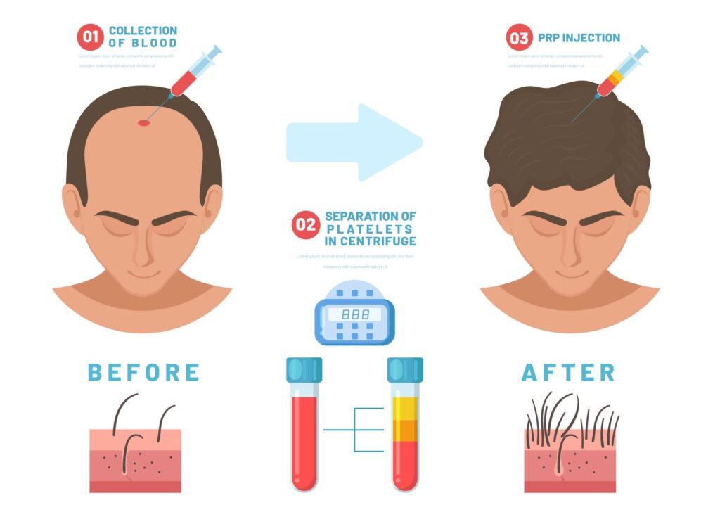 PRP hair treatment in chennai-Dermis Care- porur & KIlpauk