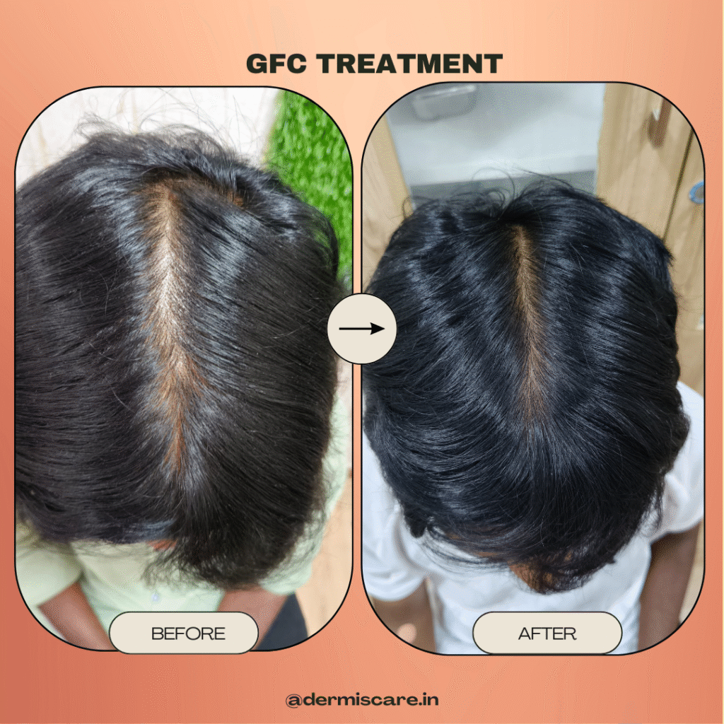 How to Minimize Risks After Hair Transplant