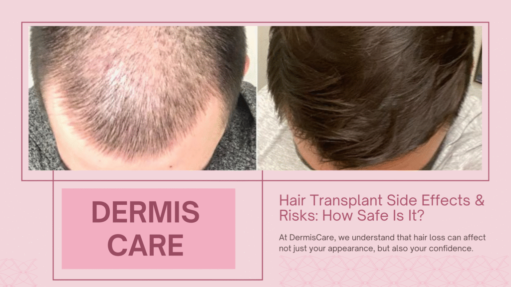 Hair Transplant Side Effects & Risks: How Safe Is It? | DermisCare