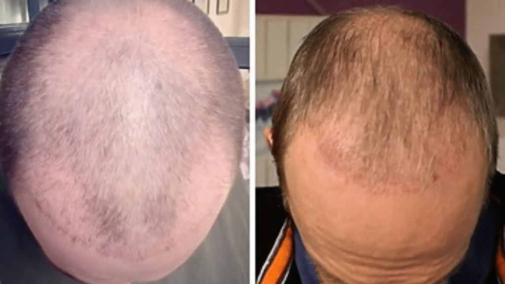 Common Side Effects of Hair Transplant (Short-Term)