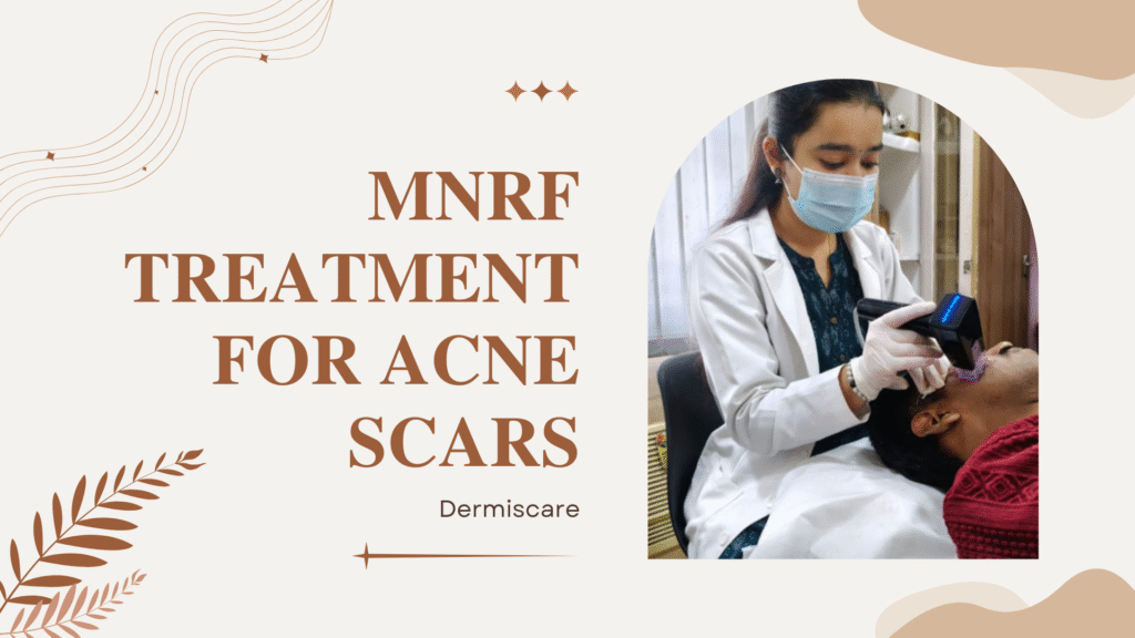 MNRF treatment for acne scars