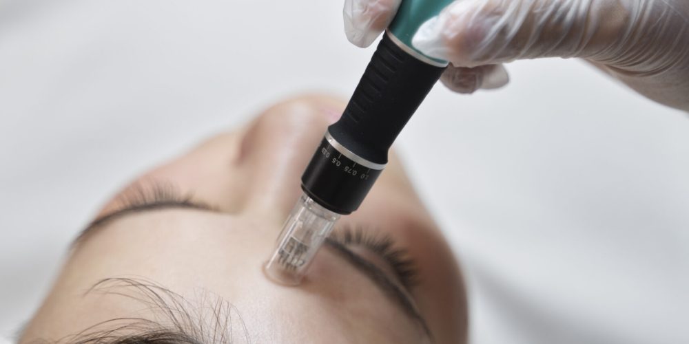 micro-needling-mnrf-treatment_dermiscare-scaled - dermisecare