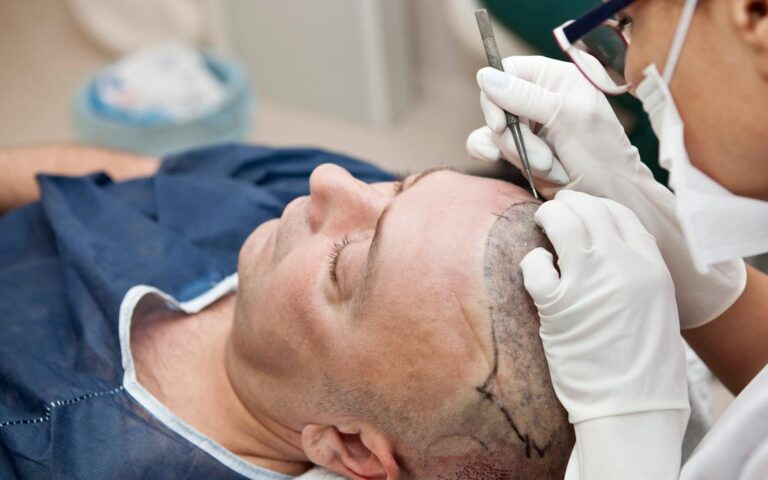 fue-fut hair transplant treatment