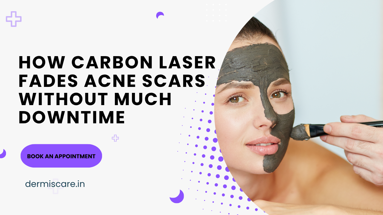 carbon laser treatment in chennai
