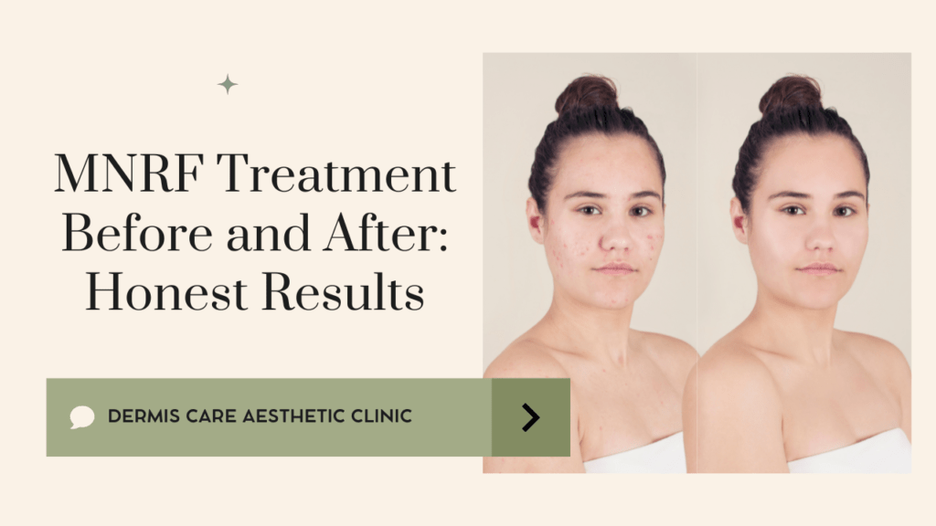 MNRF Treatment Before and After: Honest Results