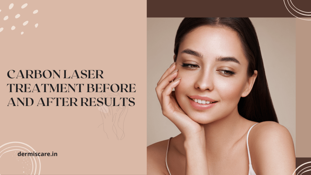Carbon Laser Treatment Before and After Results