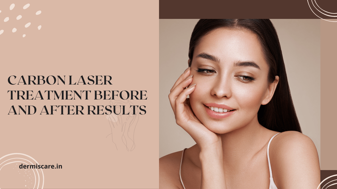 Carbon Laser Treatment Before and After Results