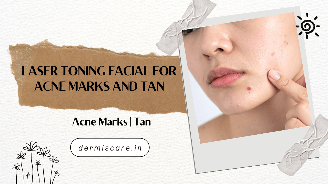 Laser Toning Facial for Acne Marks and Tan