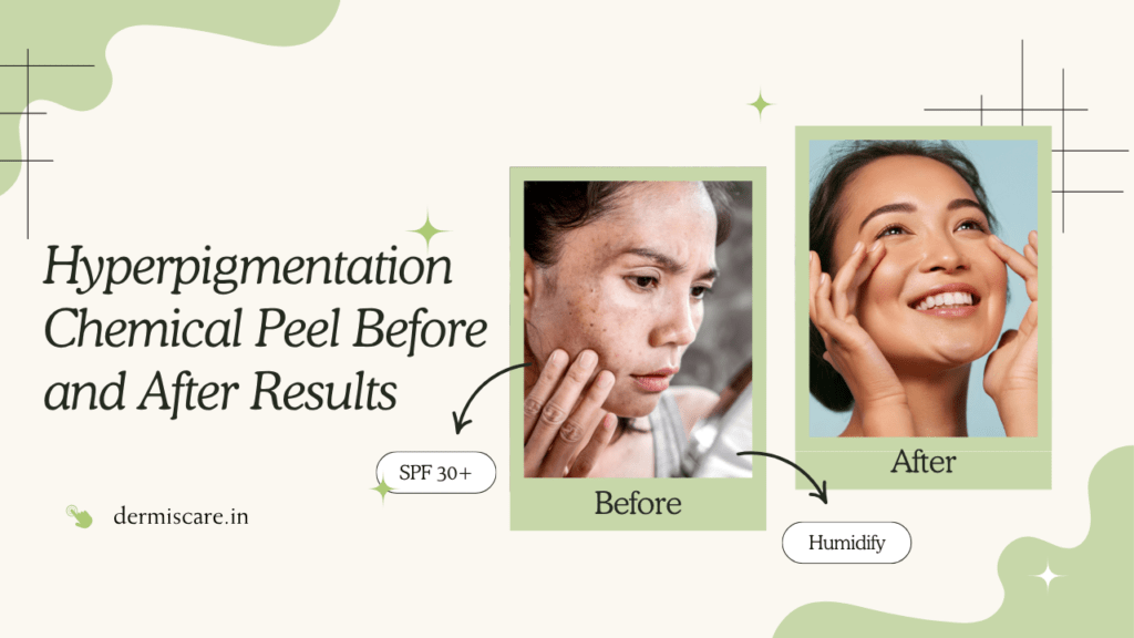Hyperpigmentation Chemical Peel Before and After Results