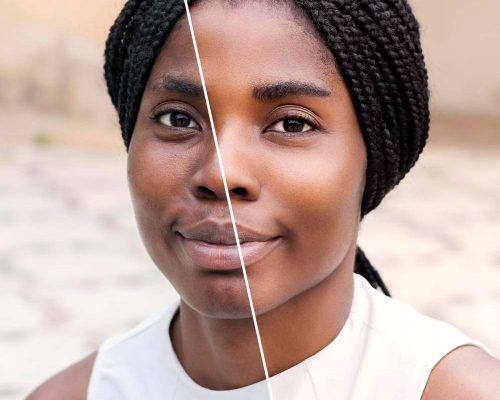 Glutathione Injection for Skin Whitening: What You Must Know