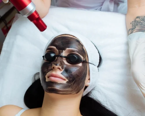 Carbon Laser Facial-Dermiscare-porur & kilpauk