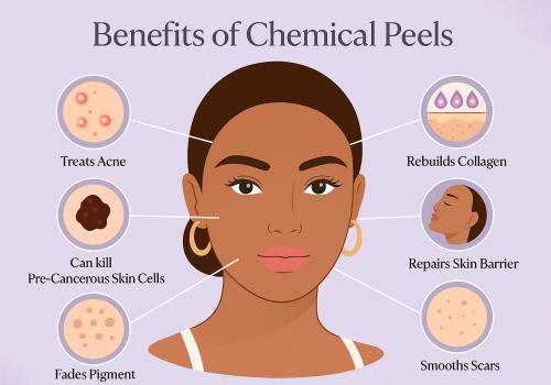 Chemical Peel Treatment-Dermiscare-kilpauk & porur Chemical Peel Treatment-Dermiscare-kilpauk & porur