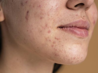 Chemical peels -dermiscare-porur & Kilpauk