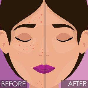 Chemical peels benefits-dermiscare-porur & Kilpauk