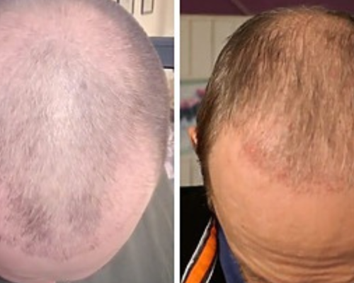 hair transplant treatment in chennai