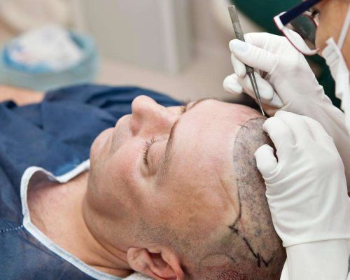 How Safe Is Hair Transplant Surgery - dermisecare