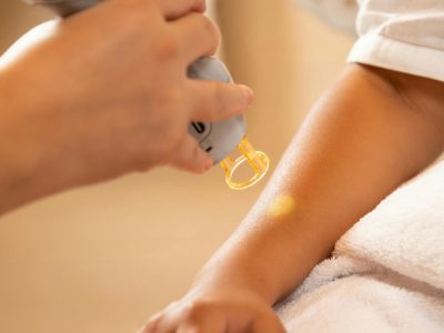 Laser Hair Reduction in Chenni-Dermiscare-porur & Kilpauk Laser Hair Reduction in Chenni-Dermiscare-porur & Kilpauk