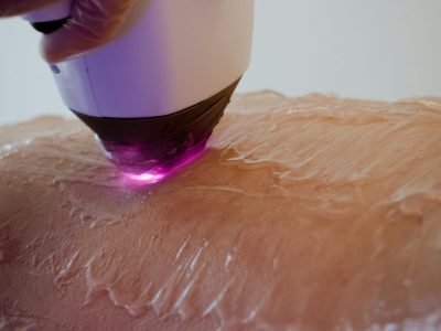 Laser Skin Rejuvenation in chennai