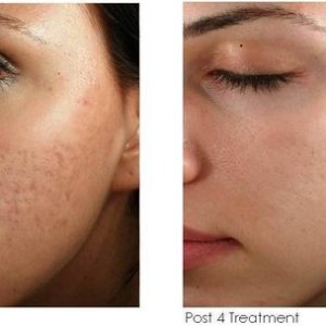 mnrf skin treatment in chennai