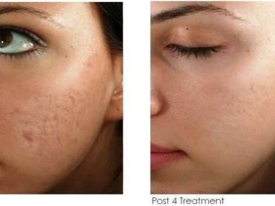 mnrf treatment before and after