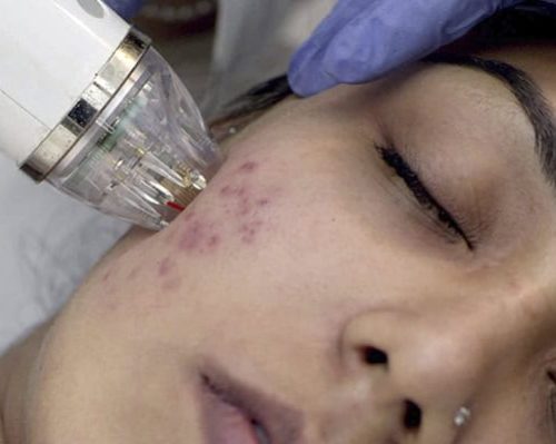 mnrf skin treatment in chennai