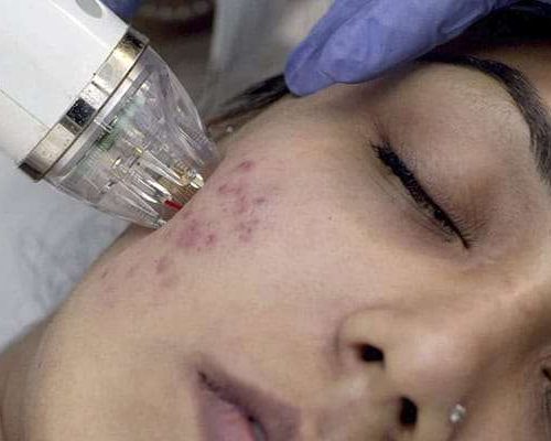 mnrf face treatment at dermiscare