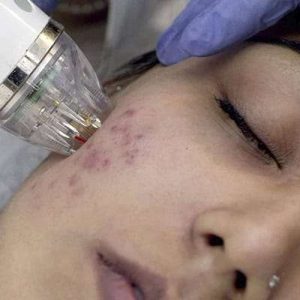 mnrf treatment before and after