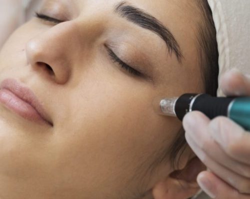 MNRF Treatment for Acne Scars - dermise care