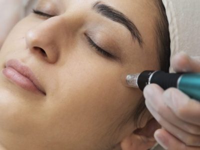 MNRF Treatment for Acne Scars - dermise care
