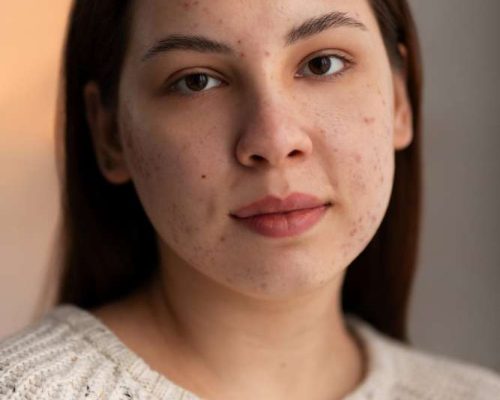 mnrf treatment before and after