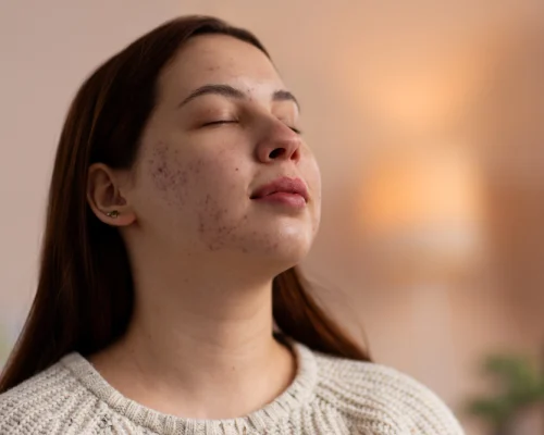 chemical peel pigmentation