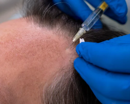 Book your Hair analysis today at Dermiscare.in and discover the right hair treatment for your hair goals.