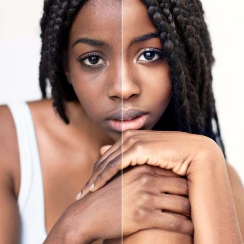 Glutathione Drip Before and After