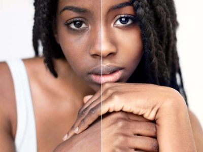 Carbon Laser Treatment Before and After