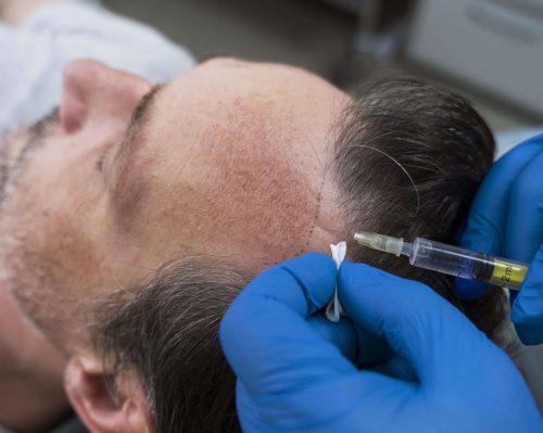 hair transplant safe or not